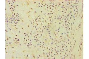 Immunohistochemistry of paraffin-embedded human breast cancer using ABIN7144871 at dilution of 1:100 (ATP5J 抗体  (AA 1-108))