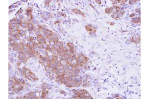 IHC-P Image MPP3 antibody detects MPP3 protein at cytosol on human breast cancer by immunohistochemical analysis. (MPP3 抗体  (Center))