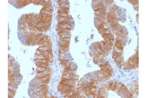 Formalin-fixed, paraffin-embedded human Ovarian Carcinoma stained with EpCAM Mouse Monoclonal Antibody (EGP40/1384).