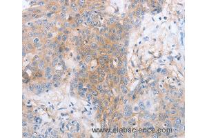 Immunohistochemistry of Human cervical cancer using LILRB2 Polyclonal Antibody at dilution of 1:30 (LILRB2 抗体)