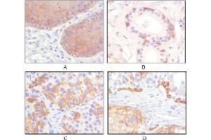 Immunohistochemical analysis of paraffin-embedded human esophagus epithelium (A), salivary gland basal cell (B), lung squamous cell carcinoma (C), endometrium admosquamous carcinoma (D), showing cytoplasmic and membrane localization using CK5 mouse mAb with DAB staining. (Cytokeratin 5 抗体)