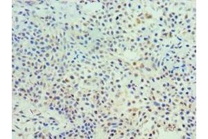Immunohistochemistry of paraffin-embedded human breast cancer using ABIN7172113 at dilution of 1:100 (TK1 抗体  (AA 1-234))