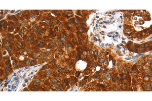 Immunohistochemistry of paraffin-embedded Human lung cancer using VWA5A Polyclonal Antibody at dilution of 1:60 (VWA5A 抗体)