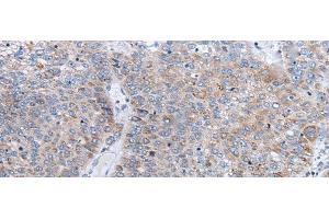 Immunohistochemistry of paraffin-embedded Human liver cancer tissue using ENPP2 Polyclonal Antibody at dilution of 1:50(x200) (ENPP2 抗体)