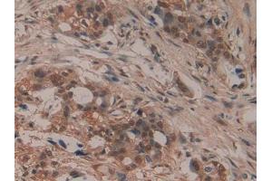 DAB staining on IHC-P; Samples: Human Pancreatic cancer Tissue (LIFR 抗体  (AA 45-184))