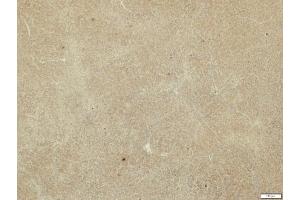 IHC-P Image MMP19 antibody detects MMP19 protein at cytosol on human hepatoma by immunohistochemical analysis. (MMP19 抗体)