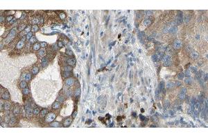 ABIN6278914 at 1/100 staining Human prostate tissue by IHC-P. (KRT23 抗体  (N-Term))