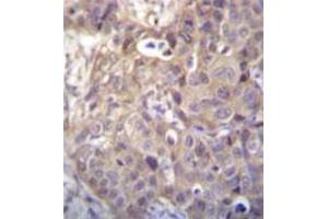 Immunohistochemistry analysis in formalin fixed and paraffin embedded human breast carcinoma recated with HIPK1 Antibody (C-term) followed by peroxidase conjugation of the secondary antibody and DAB staining. (HIPK1 抗体  (C-Term))