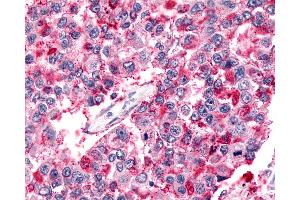 Anti-BAI2 antibody IHC of human Lung, Non-Small Cell Carcinoma. (BAI2 抗体  (N-Term))