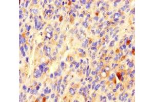 Immunohistochemistry of paraffin-embedded human melanoma using ABIN7148160 at dilution of 1:100 (CCDC84 抗体  (AA 1-200))