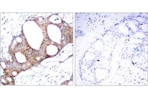 Immunohistochemistry analysis of paraffin-embedded human breast carcinoma, using GSK3 alpha (Phospho-Ser21) Antibody. (GSK3 alpha 抗体  (AA 10-59))