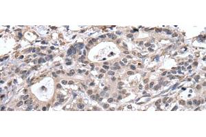 Immunohistochemistry of paraffin-embedded Human gastric cancer tissue using TRIM27 Polyclonal Antibody at dilution of 1:65(x200) (TRIM27 抗体)