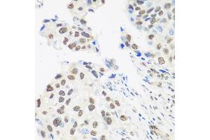 Immunohistochemistry of paraffin-embedded human prostate cancer using DDX39B antibody.