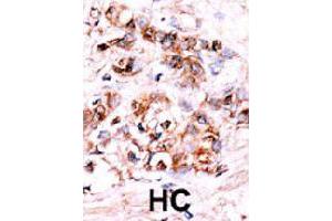 Formalin-fixed and paraffin-embedded human hepatocellular carcinoma tissue reacted with DUSP15 polyclonal antibody  , which was peroxidase-conjugated to the secondary antibody, followed by AEC staining. (DUSP15 抗体  (N-Term))