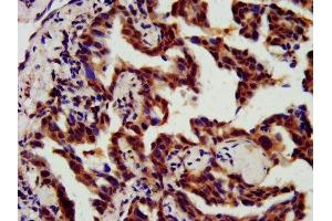IHC image of ABIN7147529 diluted at 1:800 and staining in paraffin-embedded human lung cancer performed on a Leica BondTM system. (CHMP5 抗体  (AA 1-219))