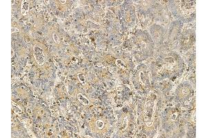 ZBTB7C Mouse Monoclonal Antibody at 1/100 staining human colorectal cancer by IHC-P. (ZBTB7C 抗体)