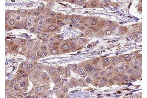 ABIN6274061 at 1/100 staining human liver carcinoma tissue sections by IHC-P. (Dynamin 1-Like 抗体  (pSer637))