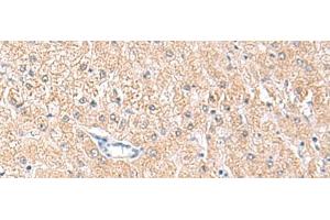 Immunohistochemistry of paraffin-embedded Human liver cancer tissue using MLKL Polyclonal Antibody at dilution of 1:85(x200) (MLKL 抗体)