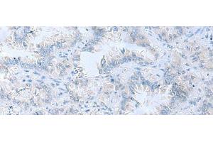 Immunohistochemistry of paraffin-embedded Human lung cancer tissue using ATP6V1C1 Polyclonal Antibody at dilution of 1:100(x200) (ATP6V1C1 抗体)
