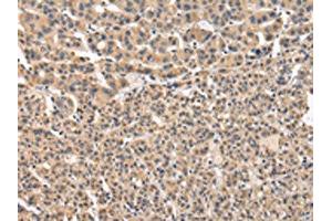 The image on the left is immunohistochemistry of paraffin-embedded Human liver cancer tissue using ABIN7131587(VPS41 Antibody) at dilution 1/20, on the right is treated with fusion protein. (VPS41 抗体)