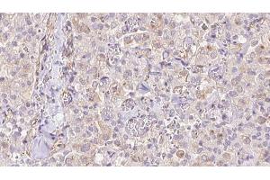 ABIN6273331 at 1/100 staining Human thyroid cancer tissue by IHC-P. (TIMM9 抗体  (C-Term))