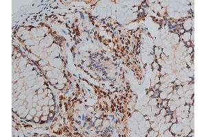 ABIN6267444 at 1/50 staining human colon cancer tissue sections by IHC-P. (GATA3 抗体  (pSer308))
