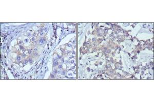 Immunohistochemical analysis of paraffin-embedded human lung cancer (left) and breast cancer (right) using RTN3 antibody with DAB staining. (Reticulon 3 抗体)
