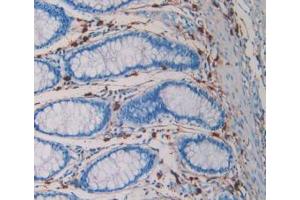 IHC-P analysis of Human Rectum Cancer Tissue, with DAB staining. (TPSAB1 抗体  (AA 161-262))