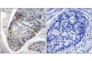 Immunohistochemistry analysis of paraffin-embedded human colon carcinoma, using Histone H1 (Phospho-Thr17) Antibody. (Histone H1 抗体  (pSer17))