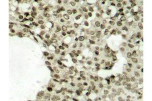 Immunohistochemistry of paraffin-embedded Human breast carcinoma tissue, using Phospho-STAT1(S727) Polyclonal Antibody (STAT1 抗体  (pSer727))