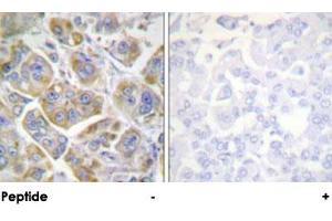 Immunohistochemical analysis of paraffin-embedded human breast carcinoma tissue using ITGB4 polyclonal antibody . (Integrin beta 4 抗体)