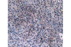 IHC-P analysis of Human Lung Cancer Tissue, with DAB staining.