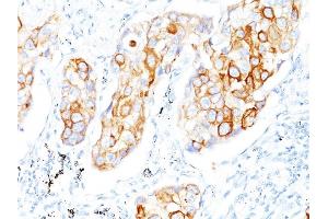 Formalin-fixed, paraffin-embedded human Lung SCC stained with Cytokeratin 7 Mouse Monoclonal Antibody (OV-TL12/30)
