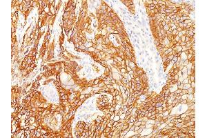 Formalin-fixed, paraffin-embedded human Lung SqCC stained with EGFR Mouse Monoclonal Antibody (GFR/2341). (EGFR 抗体  (AA 344-492))