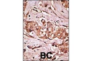 Formalin-fixed and paraffin-embedded human cancer tissue reacted with the primary antibody, which was peroxidase-conjugated to the secondary antibody, followed by AEC staining. (LRRK2 抗体  (AA 931-962))