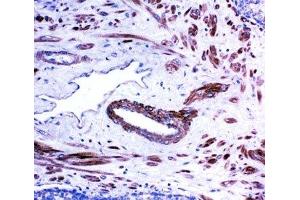 IHC-P: ACE antibody testing of human prostate cancer tissue (Angiotensin I Converting Enzyme 1 抗体  (Middle Region))