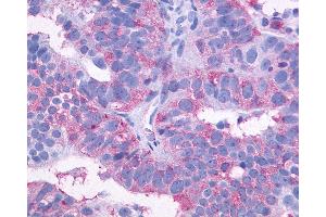 Anti-SIPR3 / EDG3 / S1P3 antibody IHC of human Ovary, Carcinoma. (S1PR3 抗体  (C-Term))