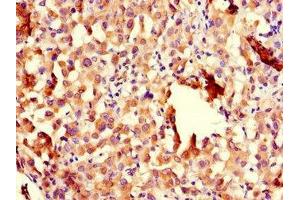 Immunohistochemistry of paraffin-embedded human lung cancer using ABIN7151005 at dilution of 1:100 (CHFR 抗体  (AA 141-422))