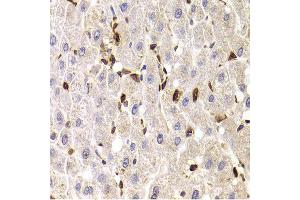 Immunohistochemistry of paraffin-embedded Human liver injury using SPN antibody at dilution of 1:100 (x400 lens). (CD43 抗体)