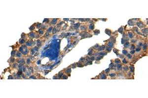 Immunohistochemistry of paraffin-embedded Human ovarian cancer tissue using DNAJC2 Polyclonal Antibody at dilution of 1:40(x200)