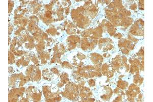 Formalin-fixed, paraffin-embedded human Thyroid Carcinoma stained with TSHRA Mouse Monoclonal Antibody (TSHRA/1402). (TSH receptor 抗体)