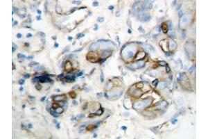 IHC-P: IP10 antibody testing of human breast cancer tissue (CXCL10 抗体  (AA 79-98))