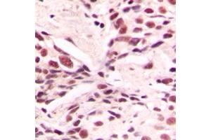 Immunohistochemical analysis of LMX1B staining in human breast cancer formalin fixed paraffin embedded tissue section. (LMX1B 抗体  (Center))