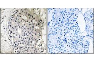 Immunohistochemistry analysis of paraffin-embedded human breast carcinoma tissue, using ARHGEF10 Antibody. (ARHGEF10 抗体  (AA 339-388))