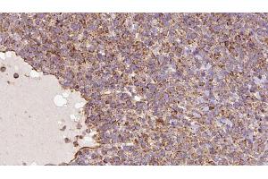 ABIN6273182 at 1/100 staining Human lymph cancer tissue by IHC-P. (UQCRC1 抗体  (C-Term))