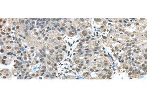 Immunohistochemistry of paraffin-embedded Human breast cancer tissue using FUS Polyclonal Antibody at dilution 1:45 (FUS 抗体)