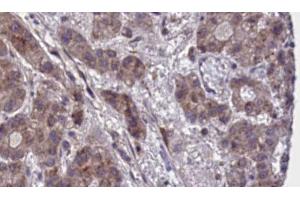 ABIN6273882 at 1/100 staining Human liver cancer tissue by IHC-P. (GPR55 抗体  (Internal Region))