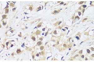 Immunohistochemistry of paraffin-embedded Human breast cancer using ASCL4 Polyclonal Antibody at dilution of 1:100 (40x lens). (ASCL4 抗体)