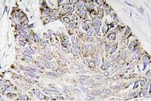 Immunohistochemistry (IHC) analyzes of Caspase-4 antibody in paraffin-embedded human lung carcinoma tissue. (Caspase 4 抗体)