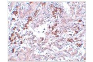 Immunohistochemistry of BCAS1 in human breast carcinoma with BCAS1 antibody at 5 µg/ml. (BCAS1 抗体  (C-Term))